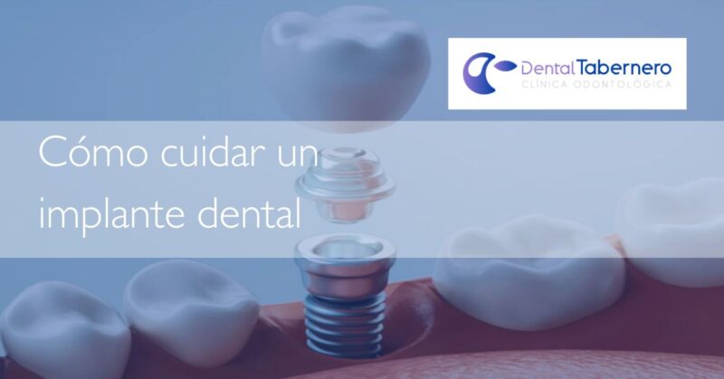 Como cuidar un implante dental Como cuidar un implante dental