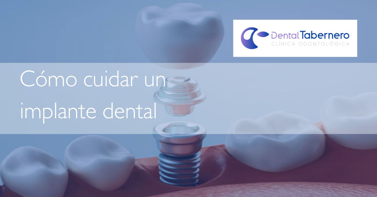 Como cuidar un implante dental Como cuidar un implante dental