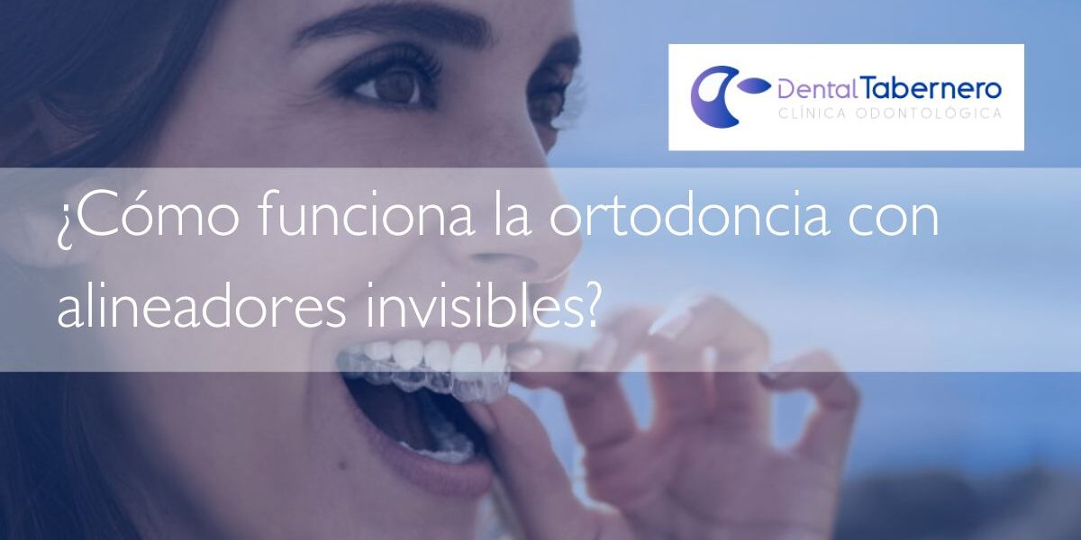 Como funciona la ortodoncia con alineadores invisibles Como funciona la ortodoncia con alineadores invisibles