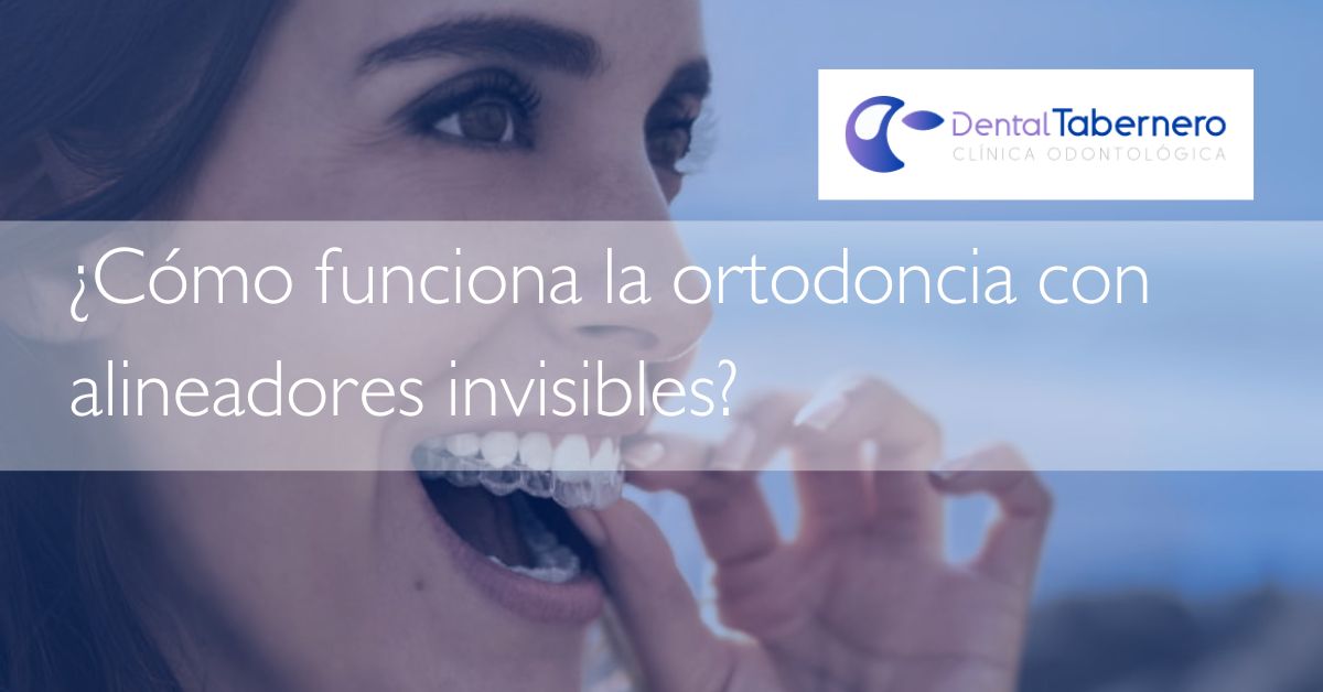 Como funciona la ortodoncia con alineadores invisibles Como funciona la ortodoncia con alineadores invisibles