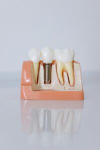 implante dental