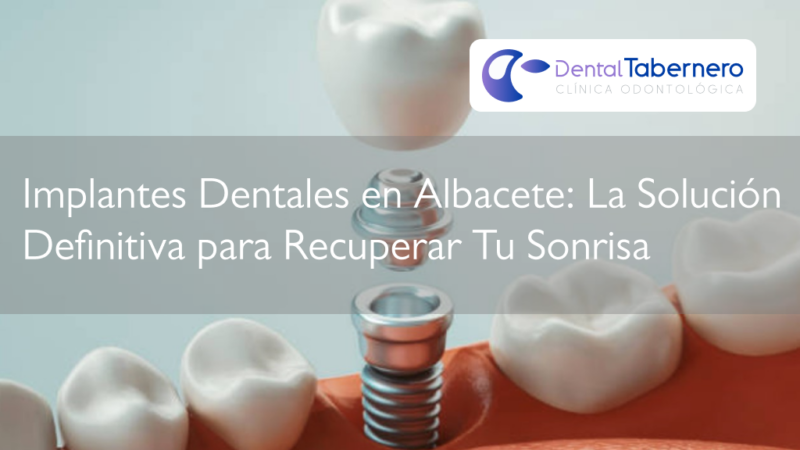 Implantes dentales en Albacete Implantes dentales en Albacete